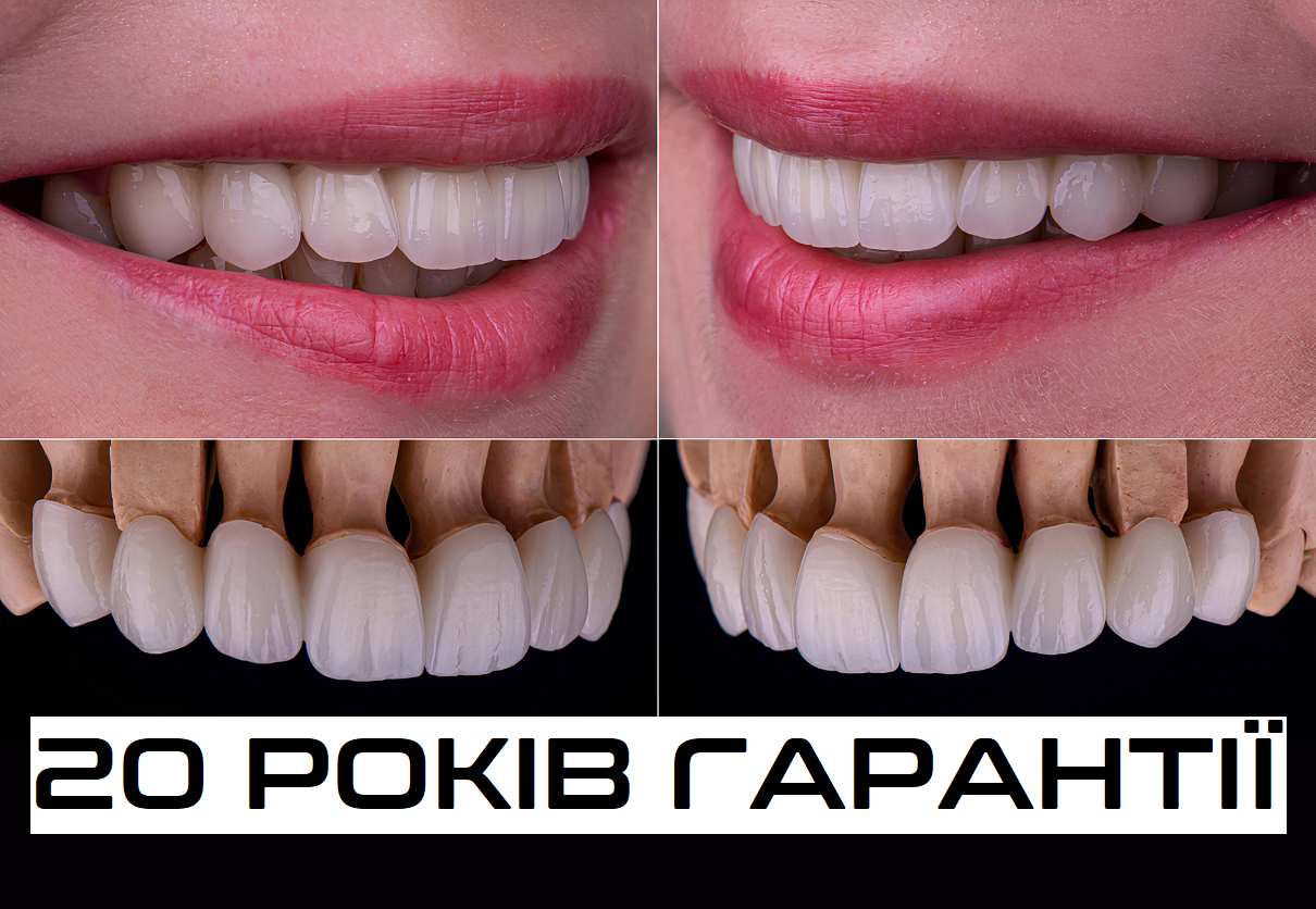 Вініри з гарантією Хмельницький